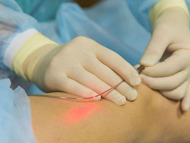 Laser Vein Removal Treatment