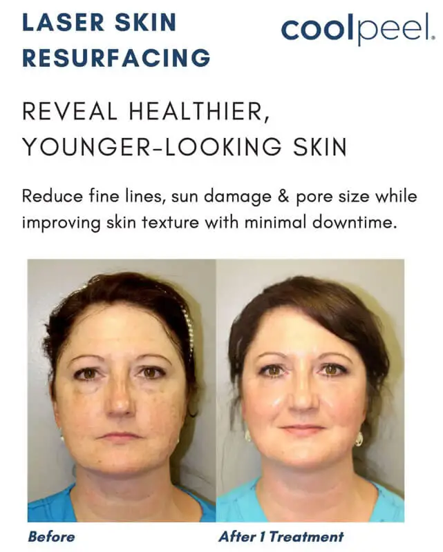 Laser Skin Resurfacing - Reveal healthier younger-looking skin