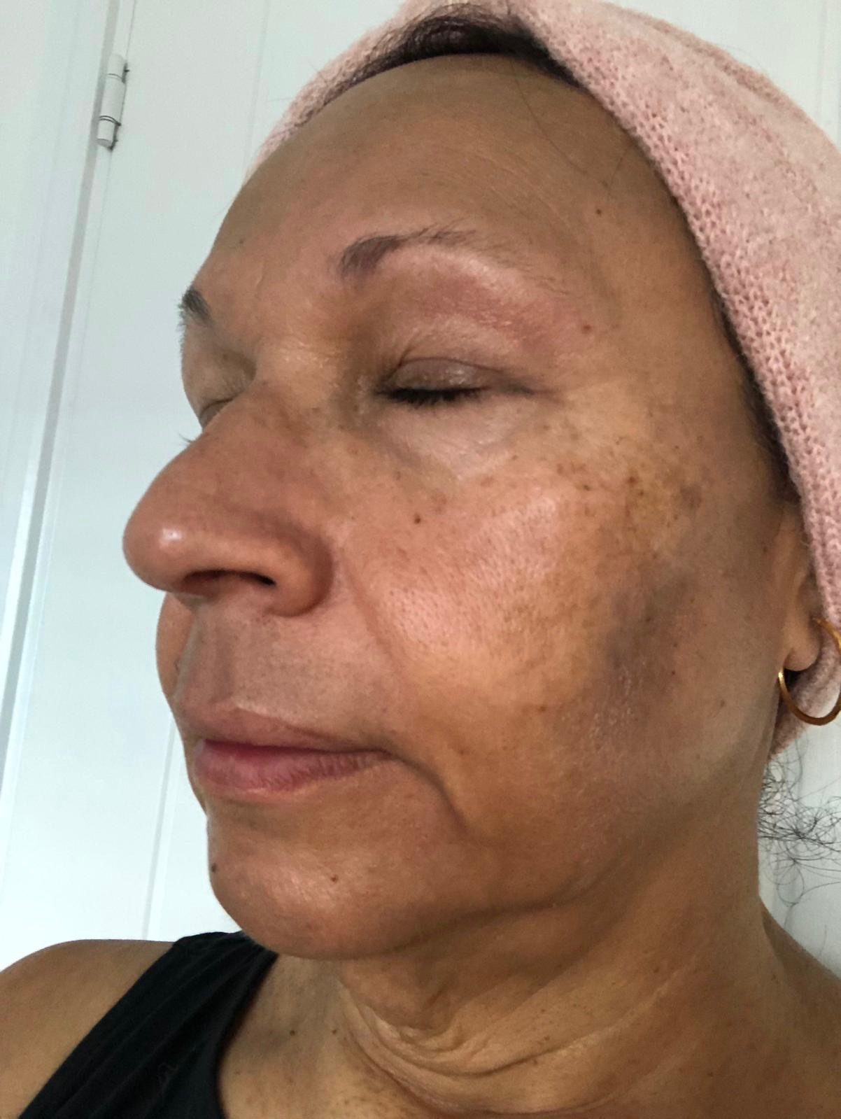 Lumi Peel skin treatment at New Skin Laser Clinic