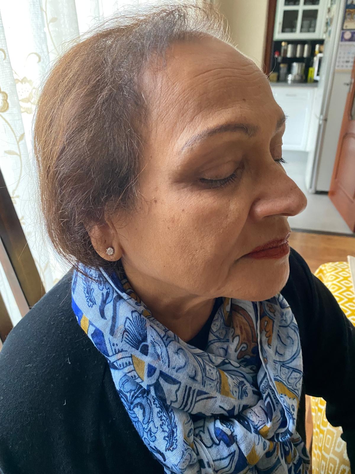 Lumi Peel melasma treatment Toronto