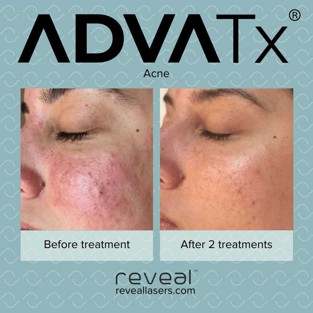 Advalight laser before and after results for acne