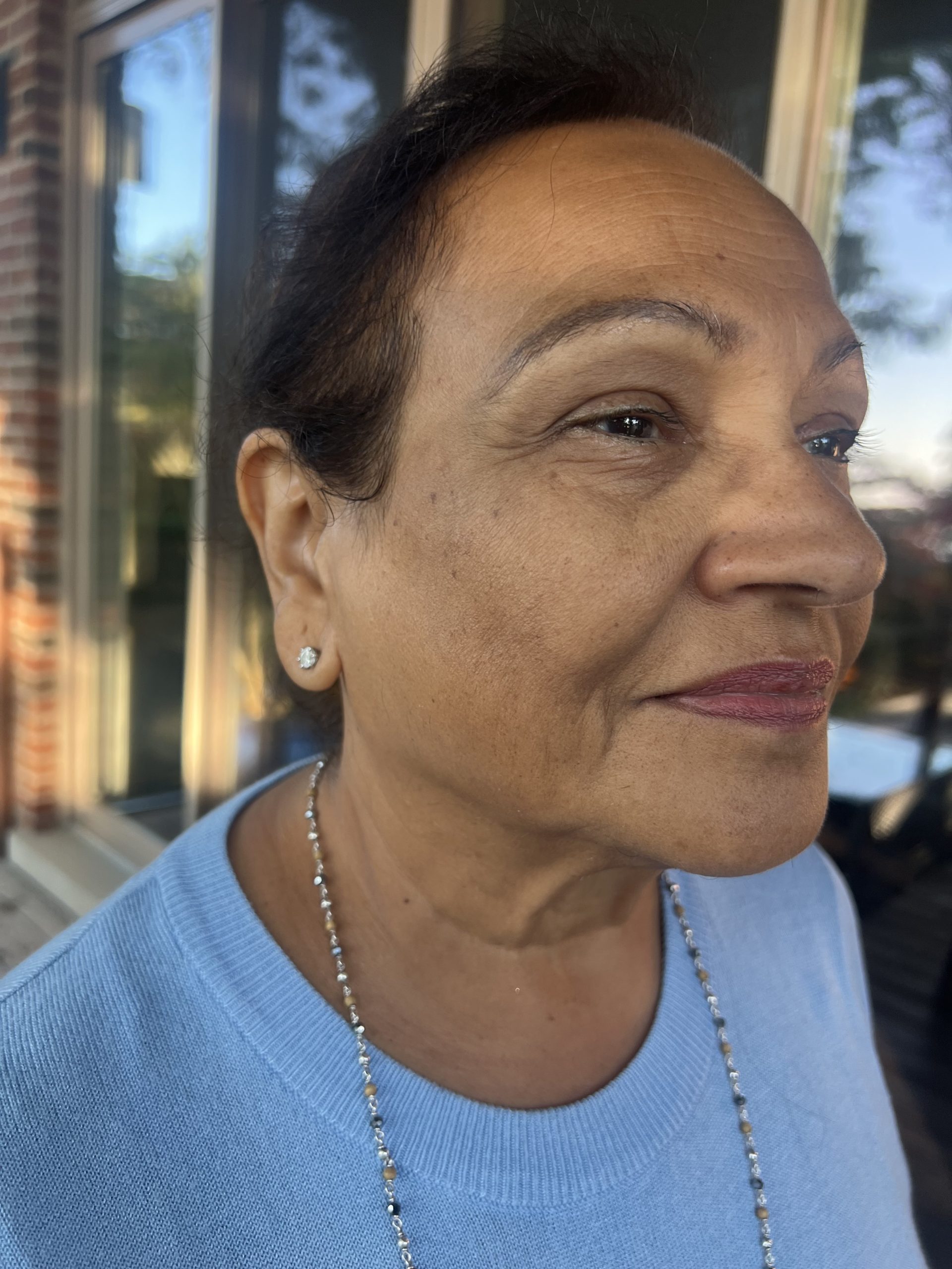 Lumi Peel pigmentation treatment Toronto