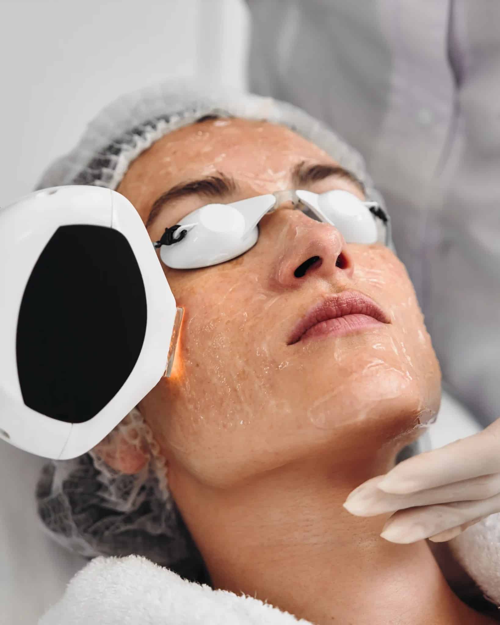 Lumecca Ipl Photofacial