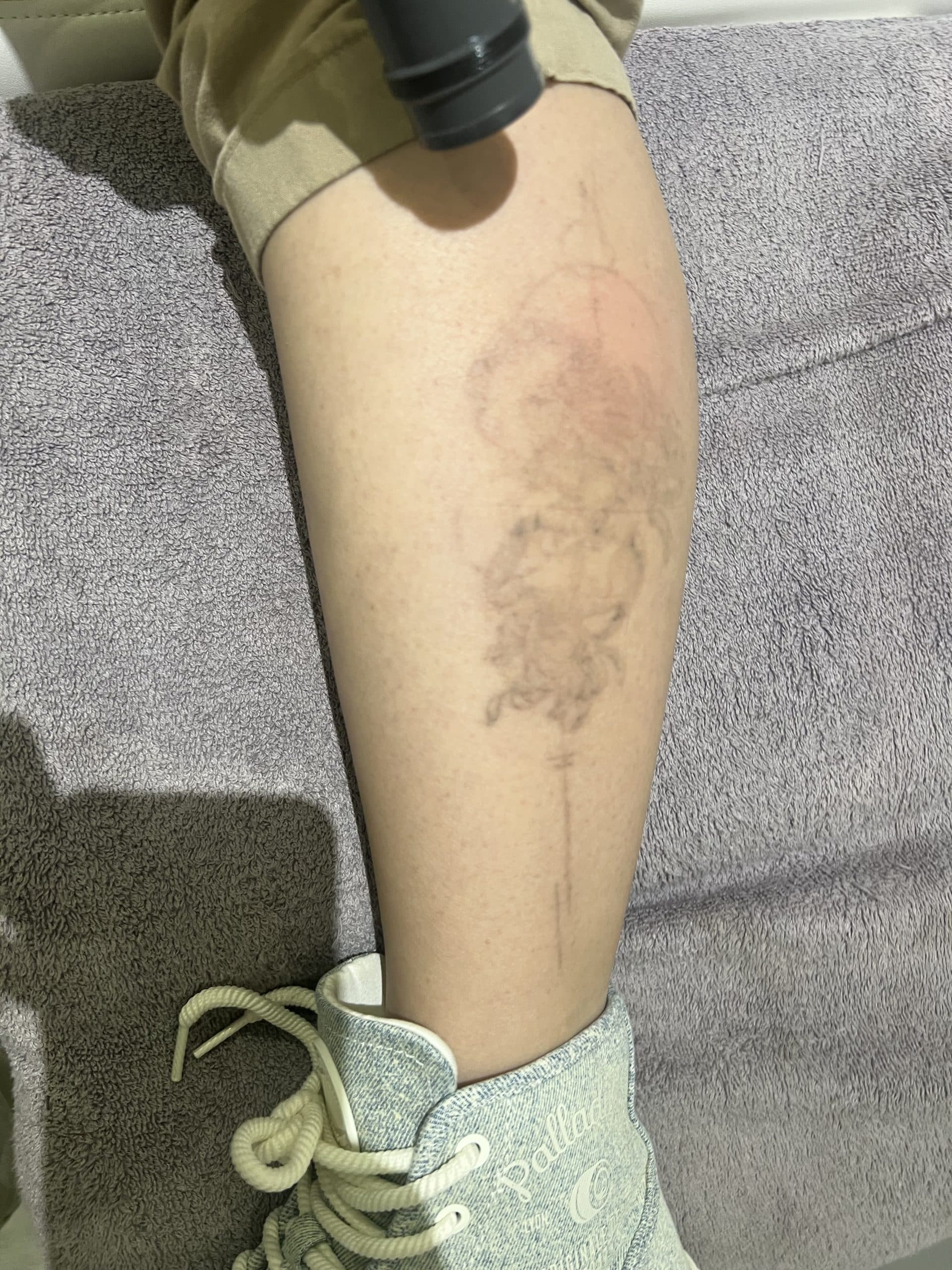 Scorpion tattoo after PicoWay removal