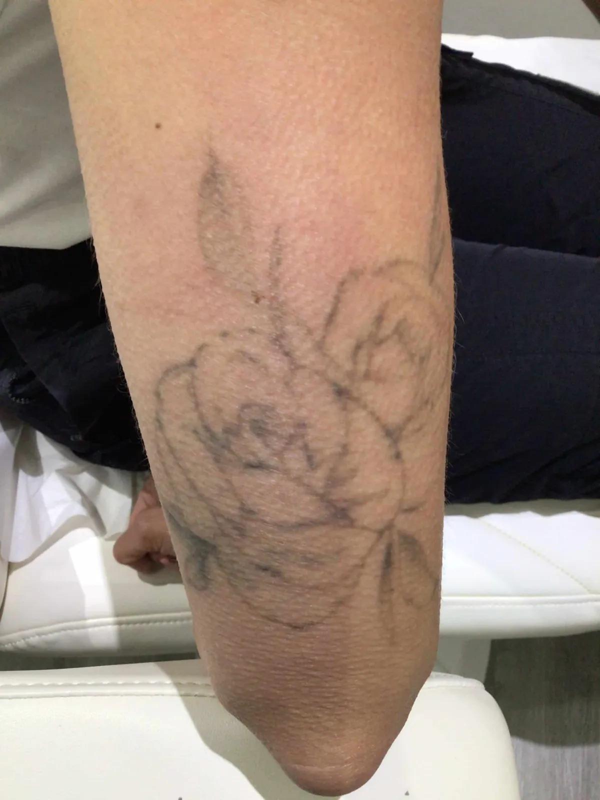 Rose tattoo after PicoWay removal
