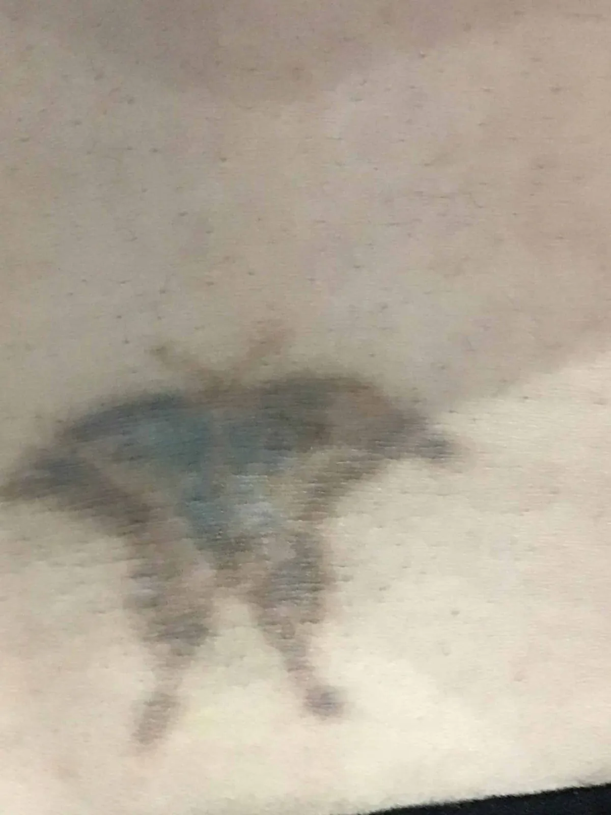 Butterfly tattoo after PicoWay removal